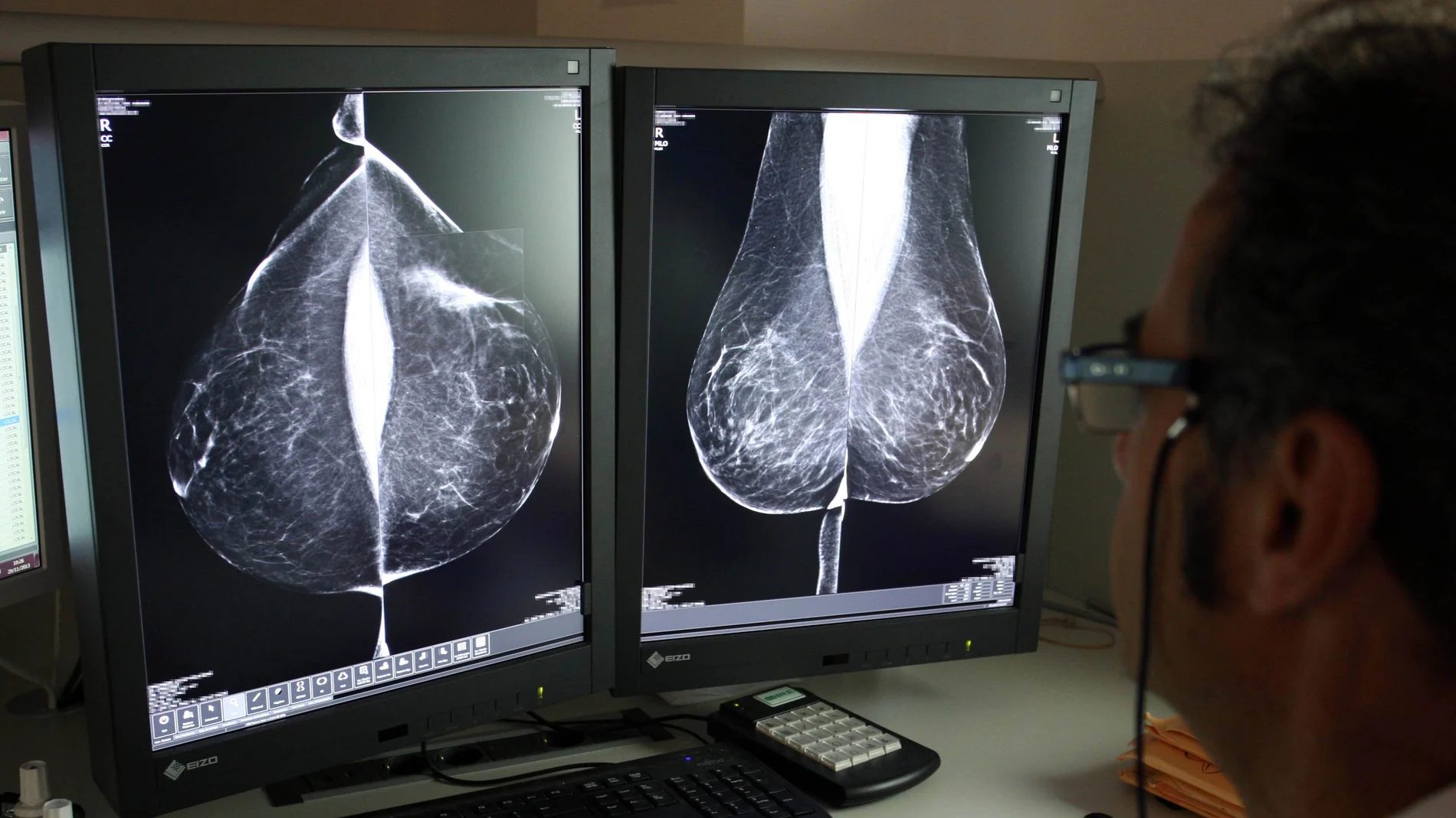 Estudio de una mamografía en el servicio del Hospital Río Hortega de Valladolid