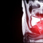 La resonancia magnética de la próstata revela, en este caso, una lesión focal anormal