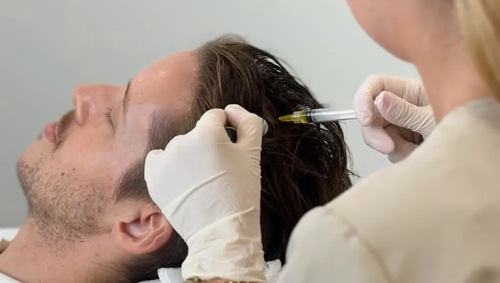 La terapia con PRP, proveniente de la medicina regenerativa capilar, es aplicable en una amplia gama de alopecias