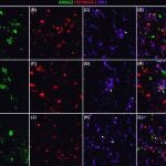Una investigación que identifica tres proteínas asociadas al Alzheimer podría mejorar diagnóstico y tratamiento