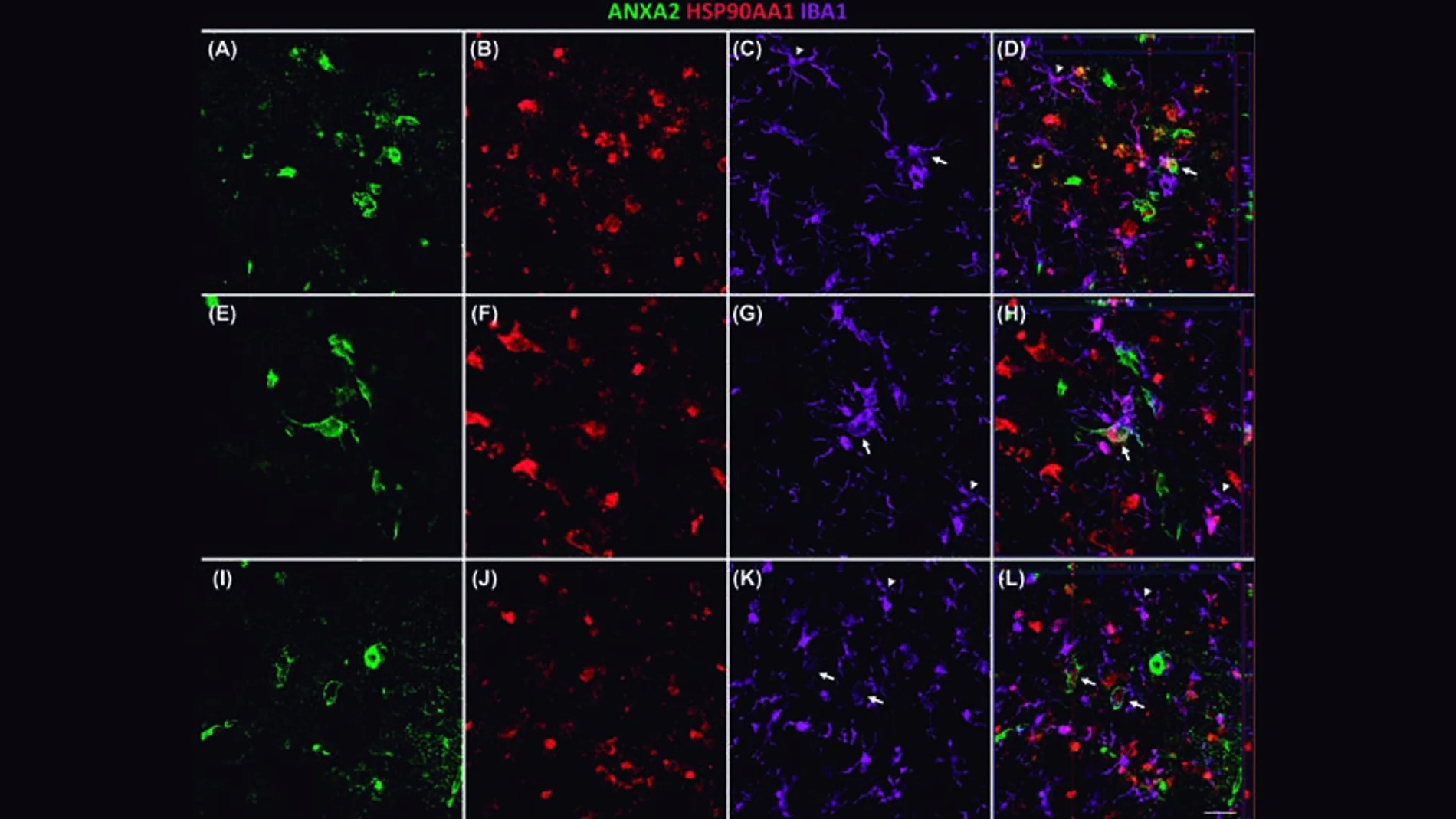 Una investigación que identifica tres proteínas asociadas al Alzheimer podría mejorar diagnóstico y tratamiento