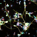 Ilustración del tumor cerebral maligno más frecuente, el glioblastoma