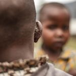 Mpox se ceba con los niños en África, aunque las lecciones aprendidas con la COVID-19 frenan su expansión