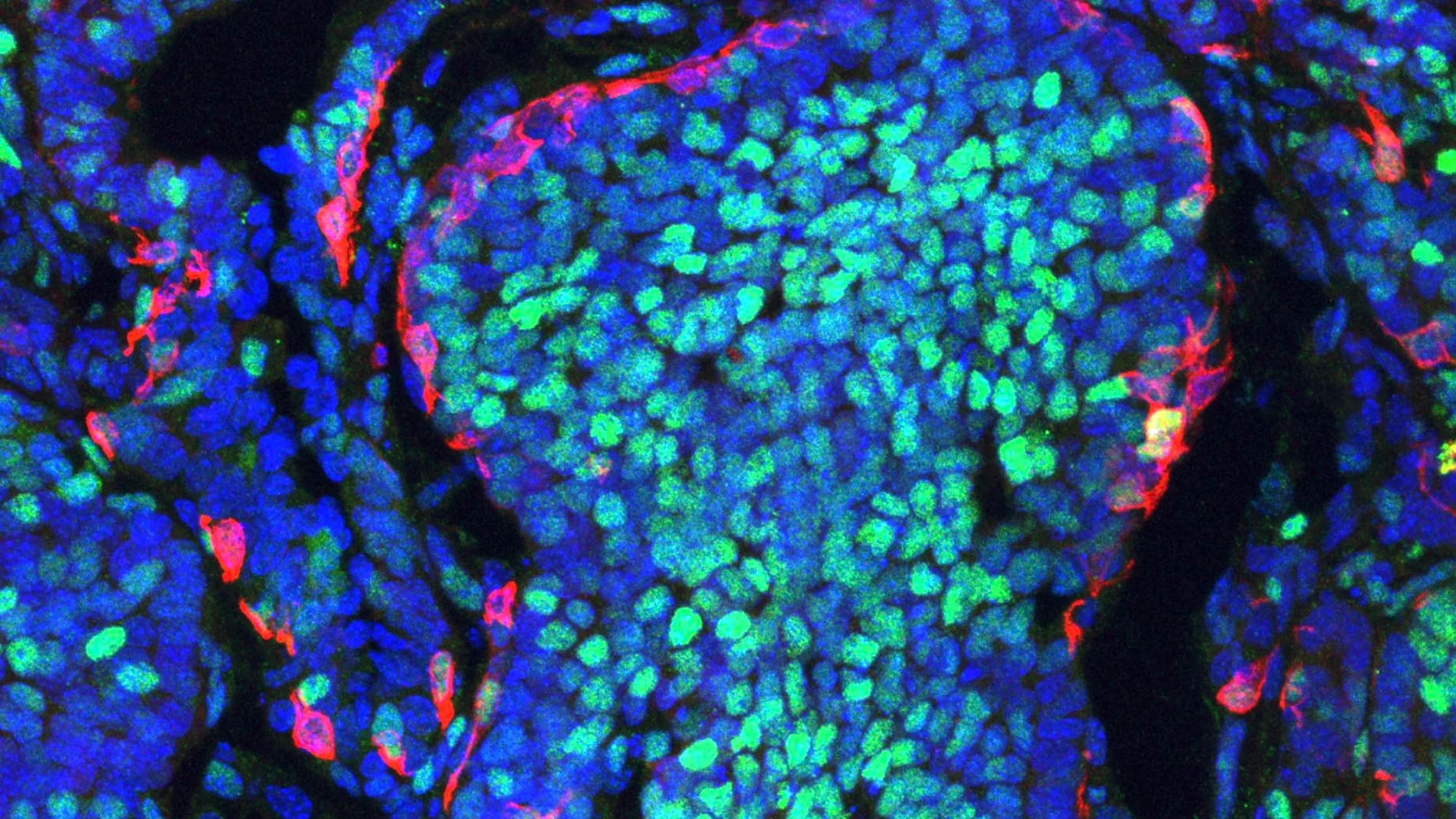 Los linfocitos T CD4 pueden jugar un papel crucial en la lucha contra el cáncer