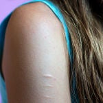 Chica joven con autolesiones en el brazo.