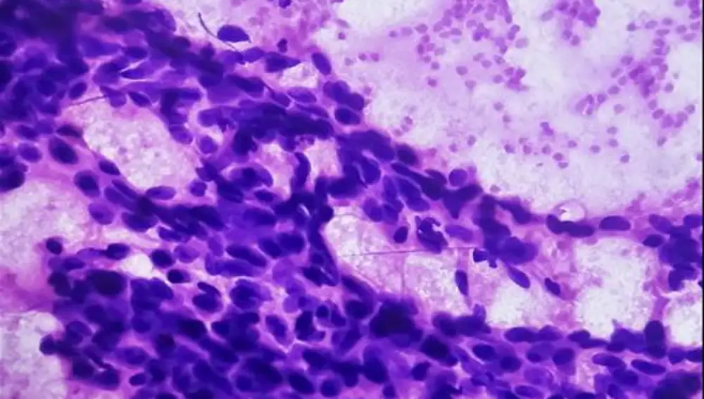 Imagen de un tumor mamario que muestra carcinoma ductal / iStock