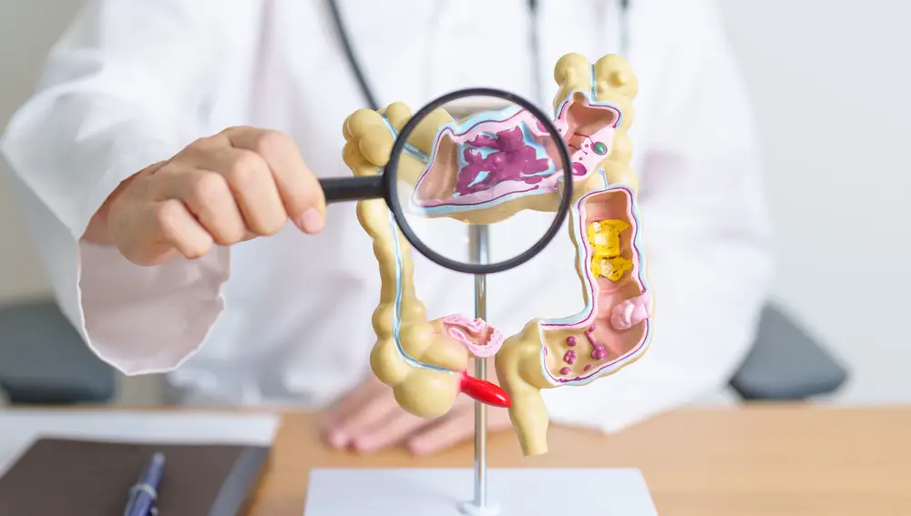El cáncer colorrectal es el tumor maligno más frecuente en España y el segundo en la tasa de mortalidad