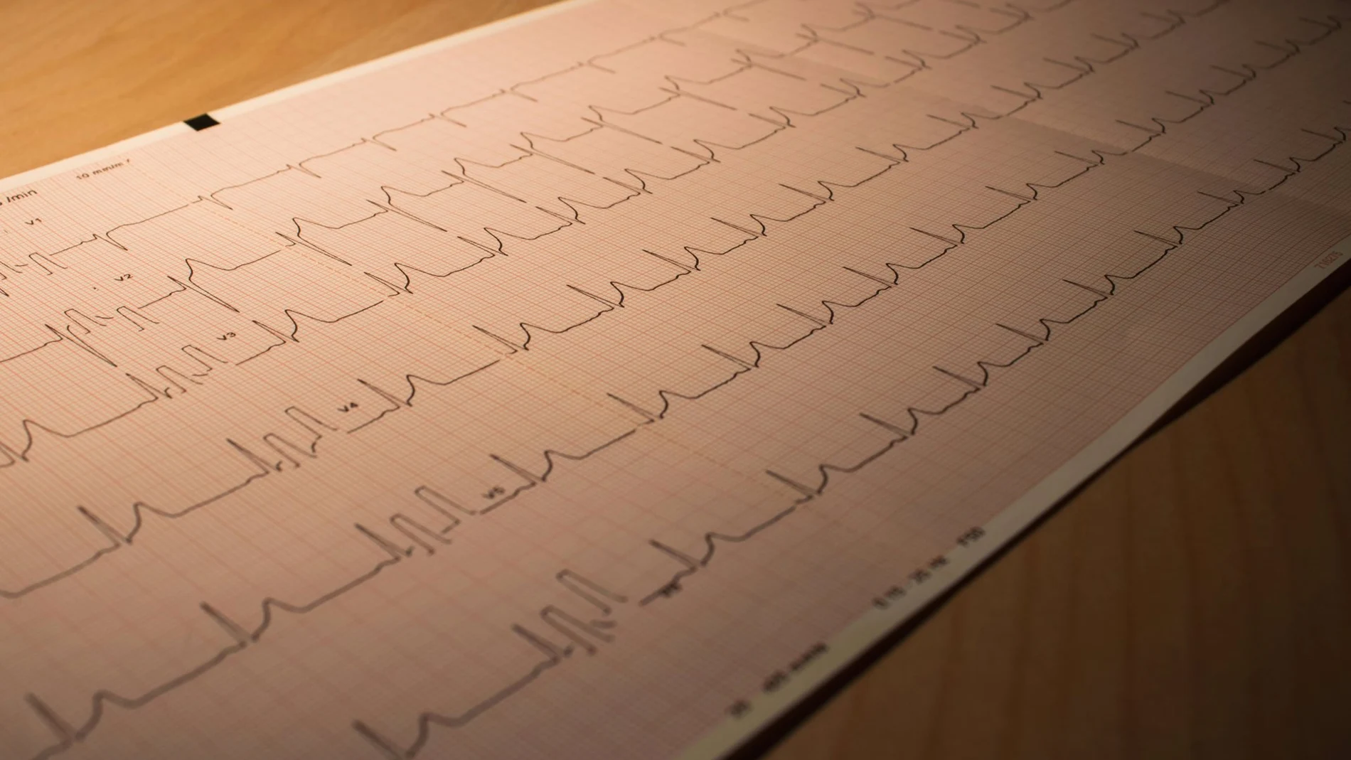 Un estudio científico identifica las señales de infarto menos reconocidas por la población
