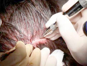 No hace falta ir a Turqu&iacute;a: as&iacute; es la t&eacute;cnica F.U.E., que erradica la calvicie en 8 horas, sin cicatrices y con anestesia local