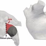 Simulaciones de la operación de fibrilación articular, realizadas por la Universitat Pompeu Fabra y el Hospital de Burdeos
