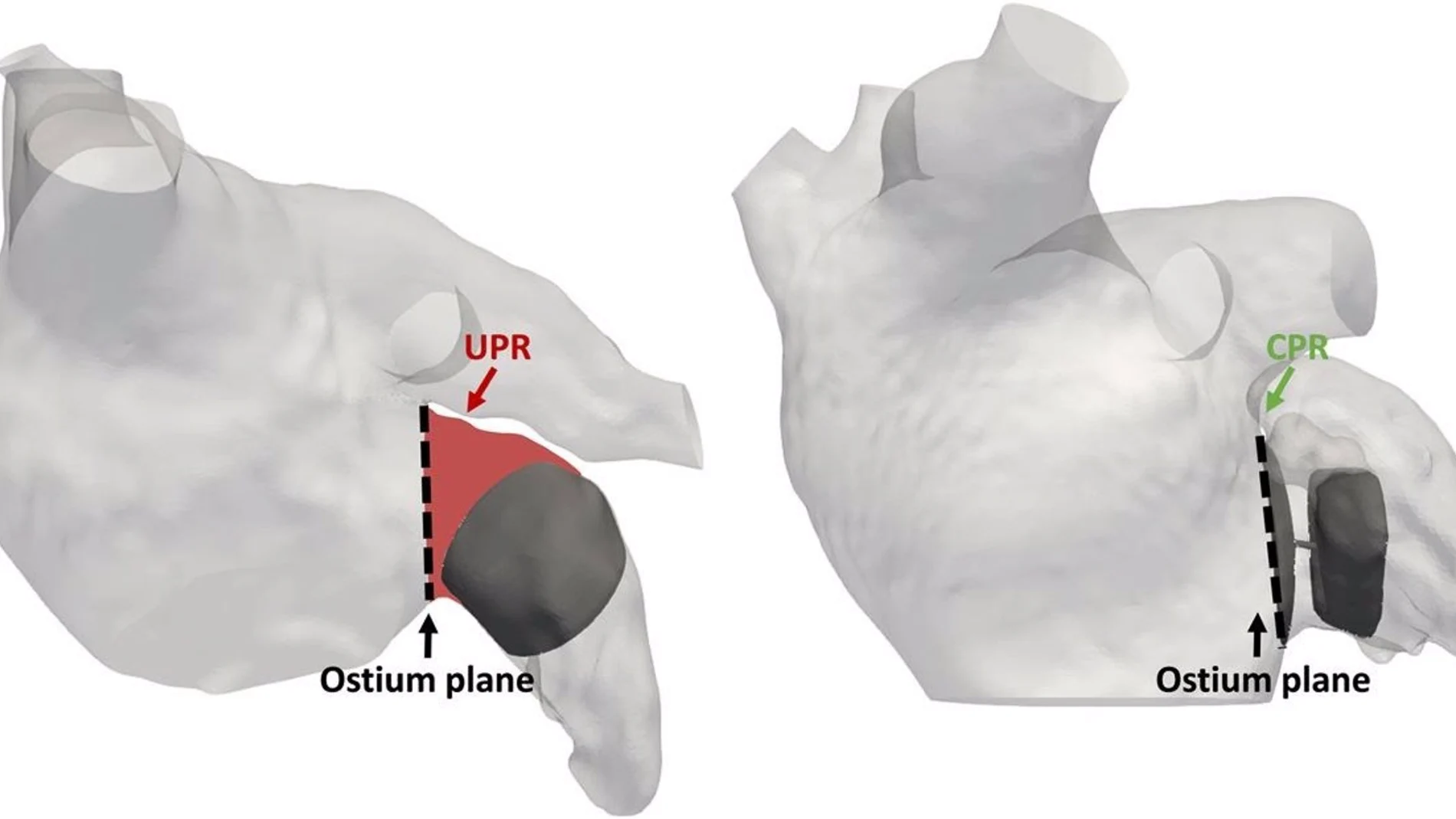 Simulaciones de la operación de fibrilación articular, realizadas por la Universitat Pompeu Fabra y el Hospital de Burdeos