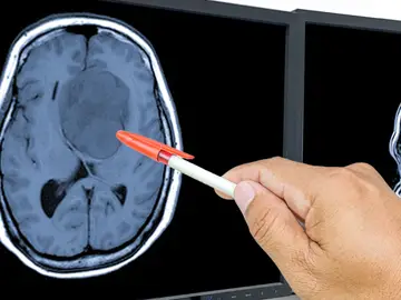 El glioblastoma es un tipo de tumor cerebral muy agresivo El glioblastoma es un tipo de tumor cerebral muy agresivo