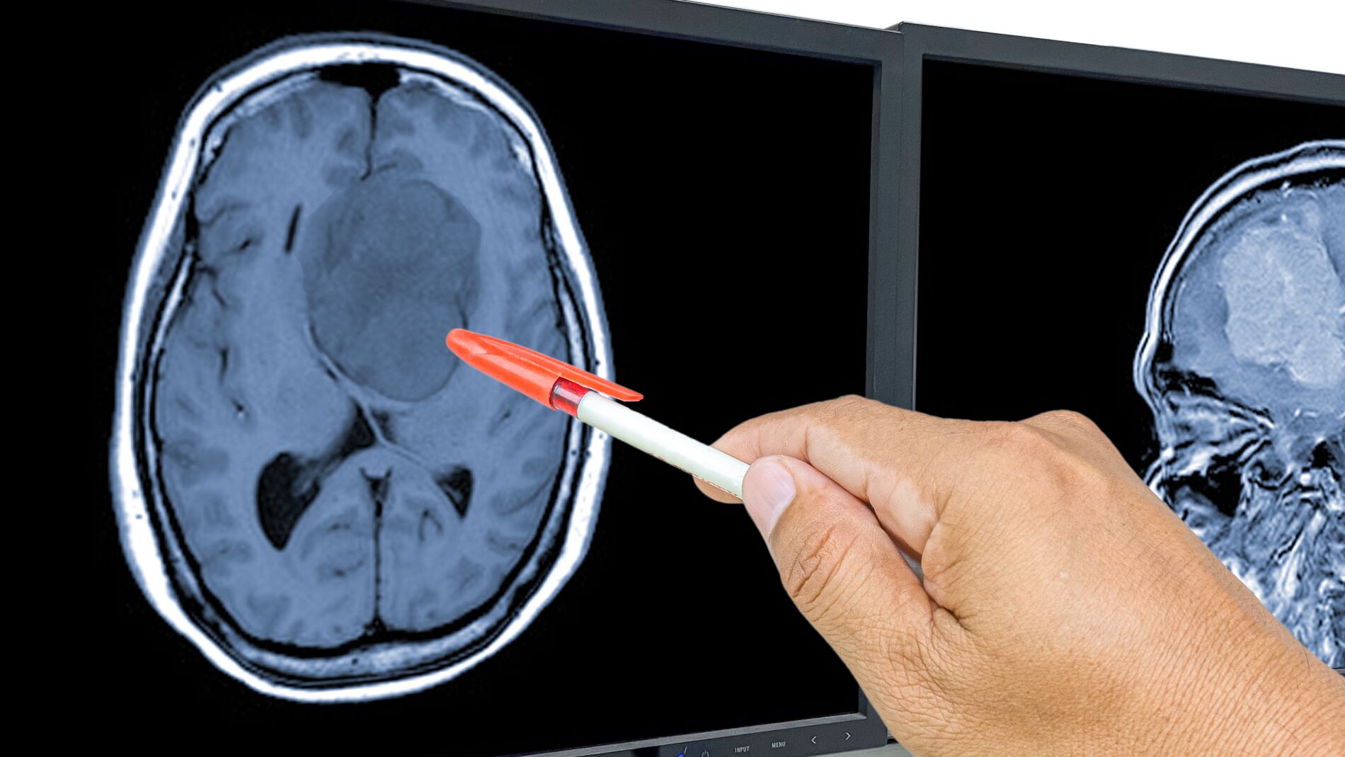 Un estudio vincula la testosterona a una mayor supervivencia en glioblastoma