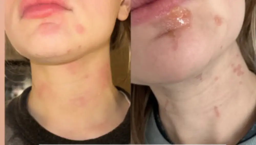 Joey King muestra sus quemaduras
