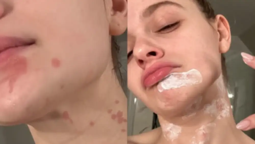 Joey King, tras su accidente en la cocina