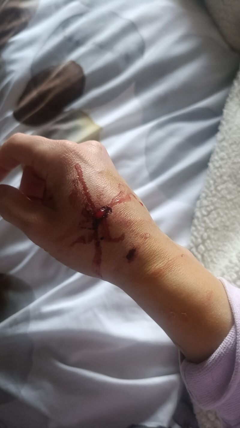 Las mordeduras del pitbull a la policía