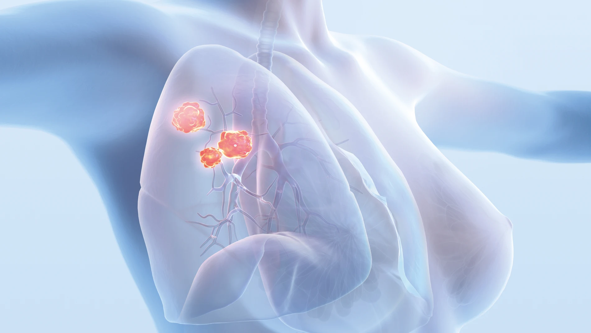 Los casos de este tumor entre el sexo femenino casi se equiparan ya a los de mama