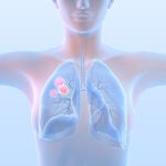 Cáncer de pulmón en mujeres