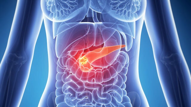 El cáncer de páncreas tiene solo un 12% de supervivencia