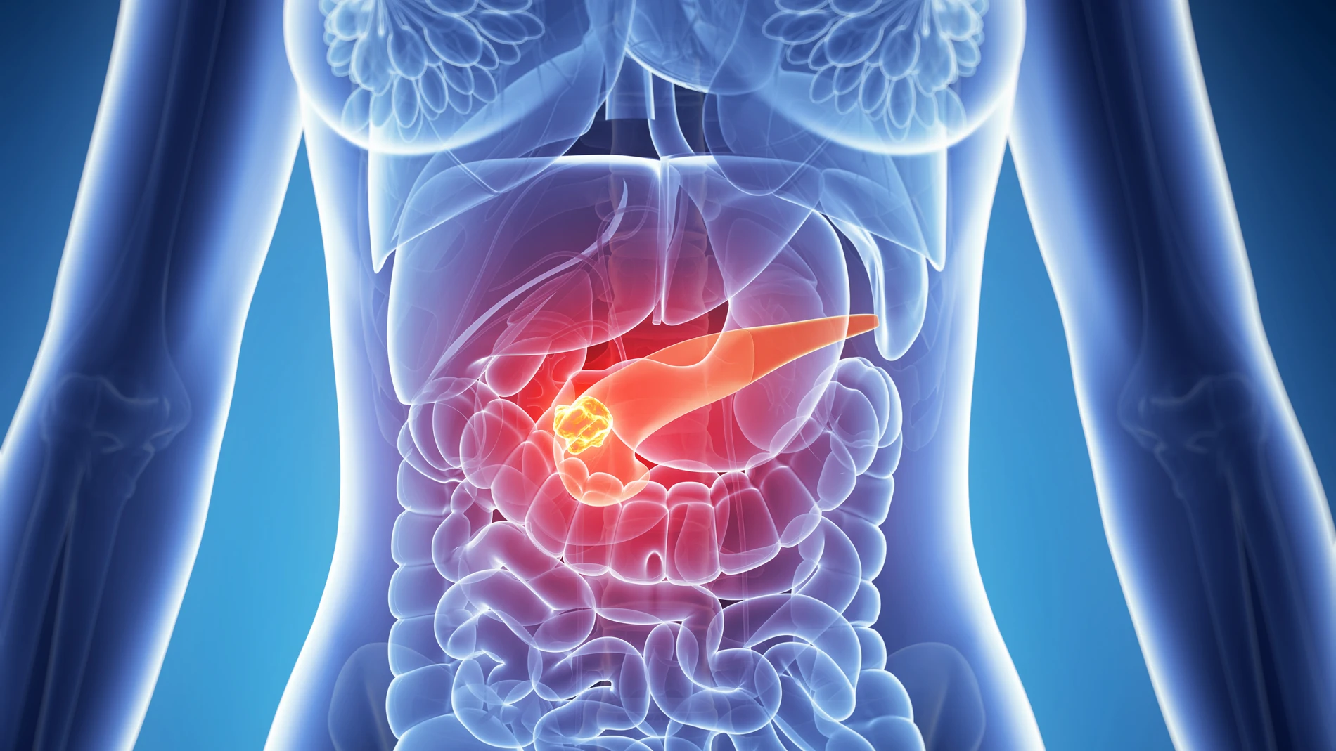 El cáncer de páncreas tiene solo un 12% de supervivencia