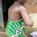 La variante más letal de la mpox puede causar una mortalidad de más del 4%