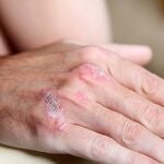 La incidencia de esta patología es de unos 60 nuevos casos por 100.000 habitantes a nivel mundial