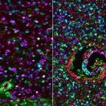 Primer análisis de muestras de tumores cerebrales antes (izquierda) y después del tratamiento (derecha), que revela una activación inmunitaria