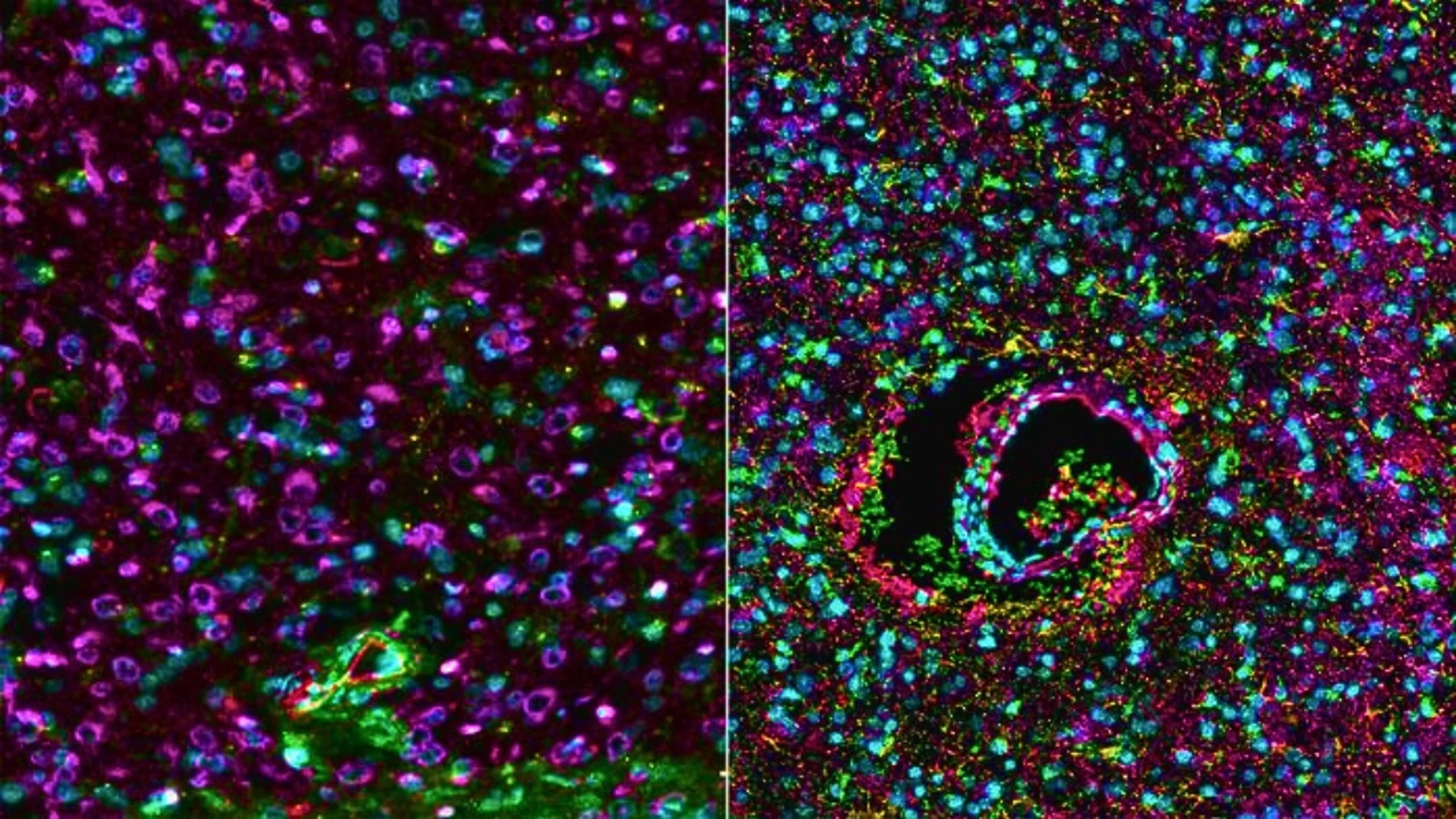 tumor cerebral antes y después del tratamiento del cáncer
