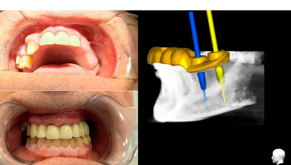 Ejemplo real: rehabilitación arcada superior y Planificación 3D de un caso real