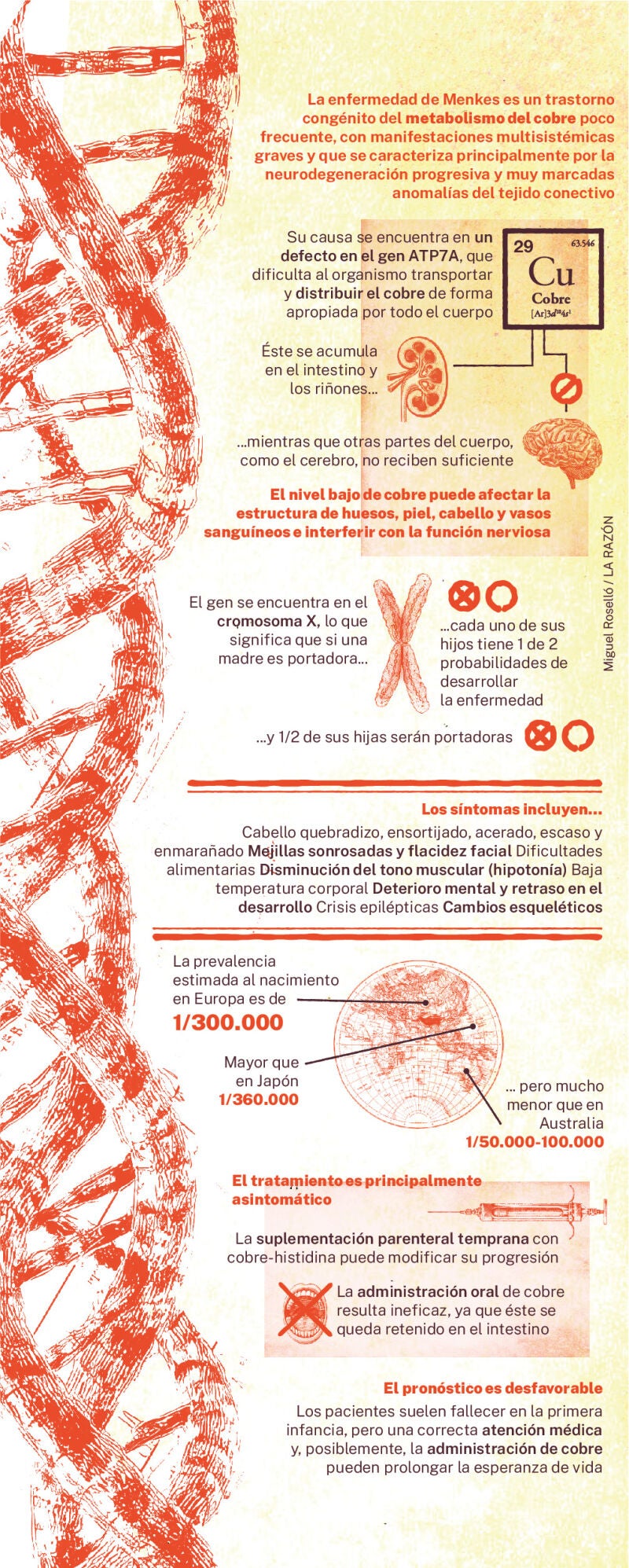 Radiografía de la enfermedad de Menkes