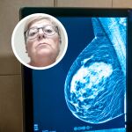 Una paciente denuncia los retrasos del cribado de cáncer de mama: "Si me lo hubieran pillado antes, no habría perdido todo el pecho"