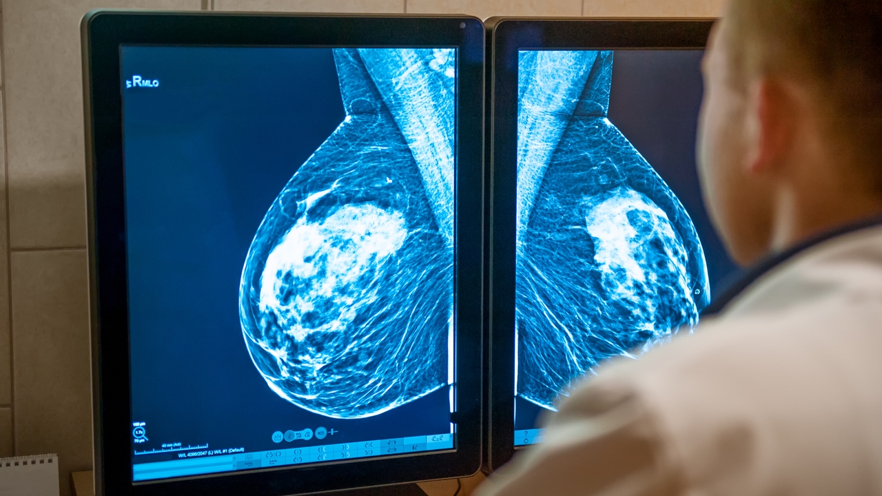 Quimioterapia en desescalada: una realidad de cada vez más pacientes con cáncer de mama