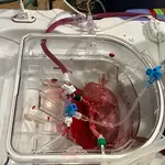 Las máquinas de perfusión normotérmica permiten insertar organoides humanos dentro de riñones porcinos