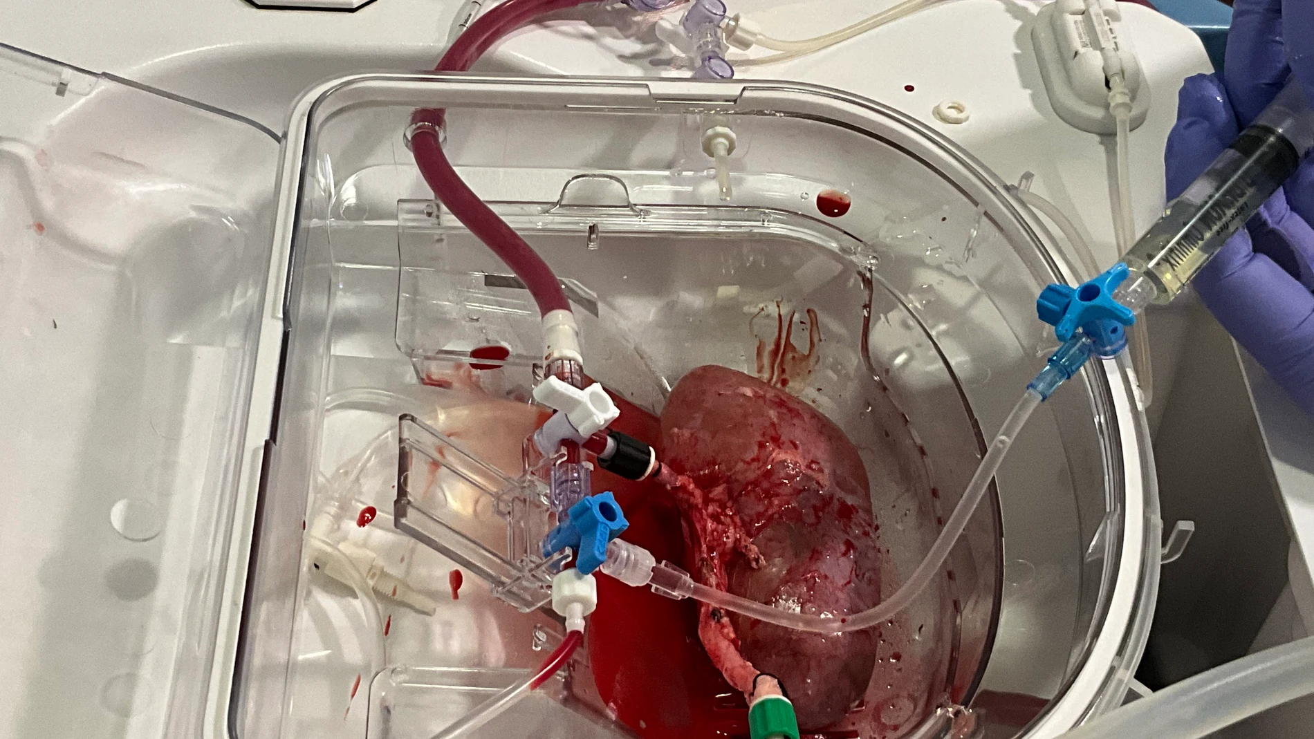 Las máquinas de perfusión normotérmica permiten insertar organoides humanos dentro de riñones porcinos