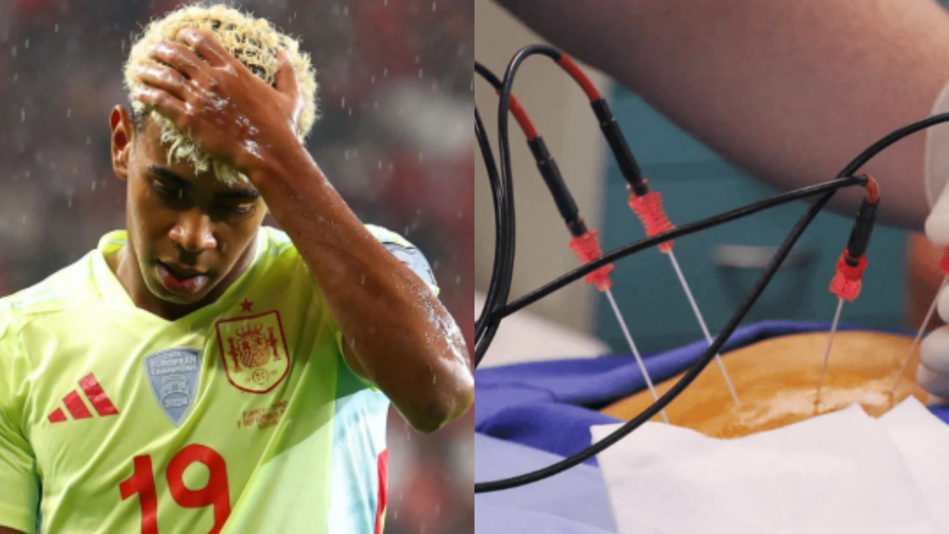 Así funciona el tratamiento de Lamine Yamal que ha desatado la guerra entre el Barça y España