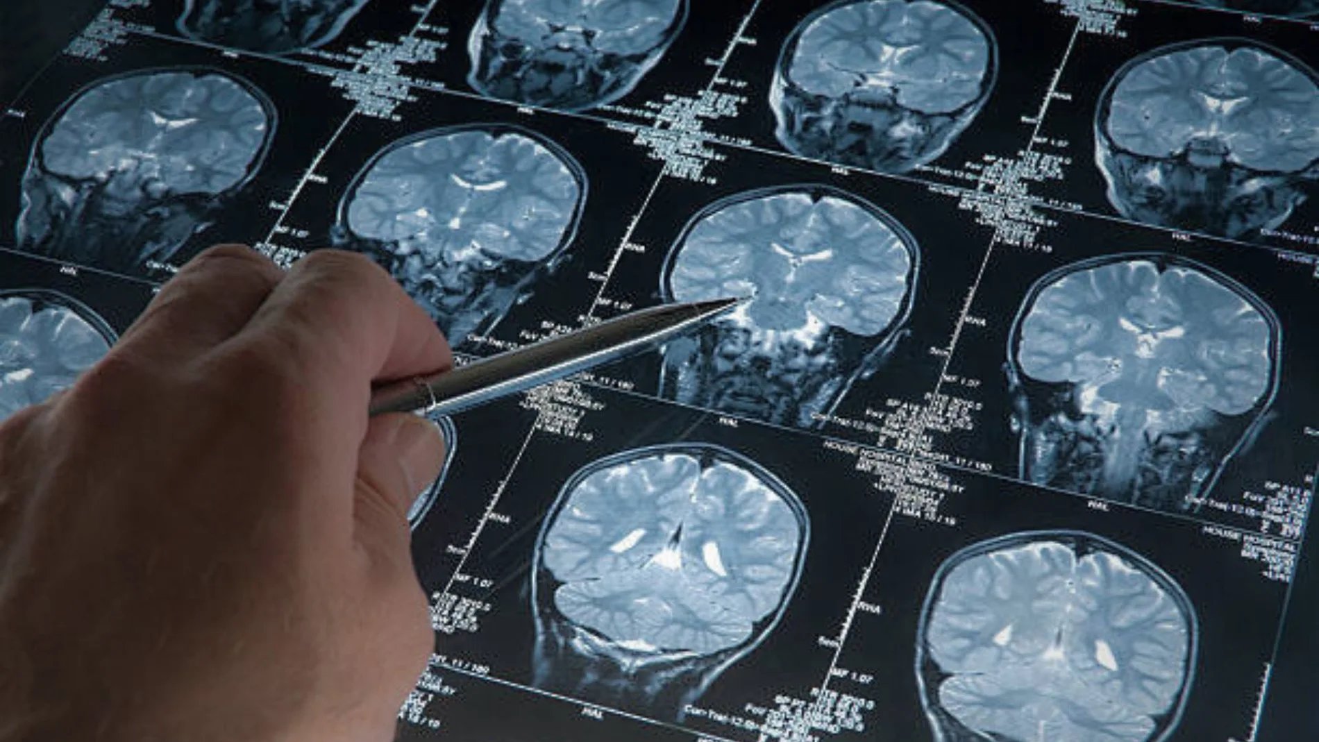 MRI, tomografía cerebral de la cabeza y cerebro