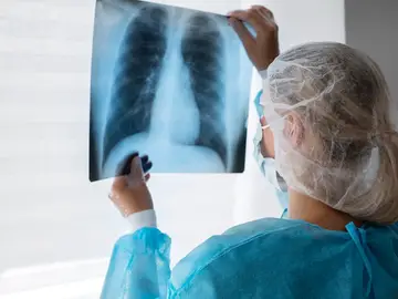 Por qué aumentan los casos de cáncer de pulmón en jóvenes y mujeres Por qué aumentan los casos de cáncer de pulmón en jóvenes y mujeres