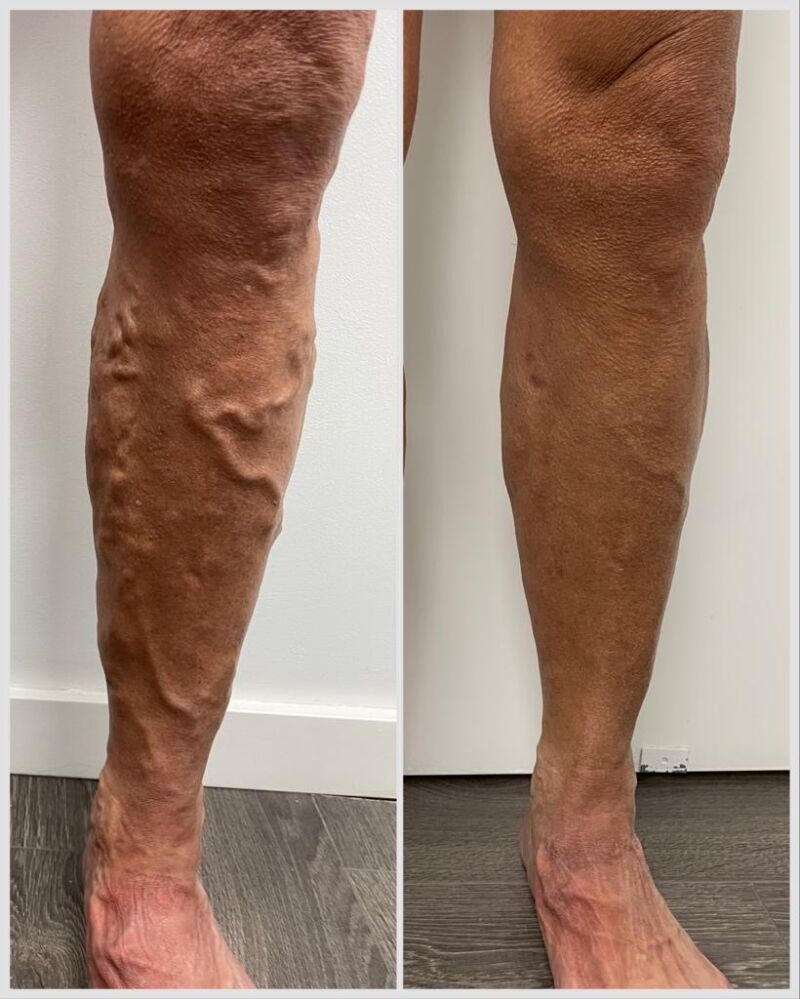 El caso de Carmelo, un paciente de Varitek, que no pudo deshacerse de sus varices con los métodos tradicionales