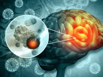 Un fármaco de uso habitual podría ralentizar el tumor cerebral más agresivo Un fármaco de uso habitual podría ralentizar el tumor cerebral más agresivo