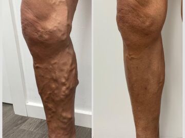 Antes y después de un paciente de Varitek tratado con procedimientos ecoguiados