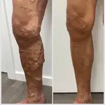 Antes y después de un paciente de Varitek tratado con procedimientos ecoguiados