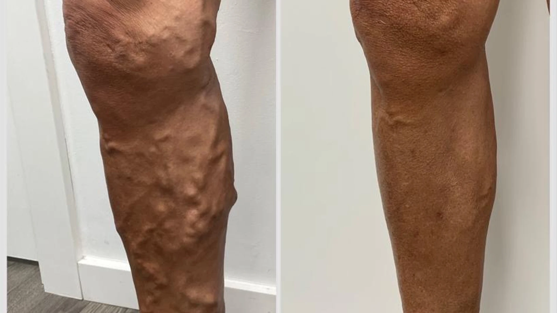 Antes y después de un paciente de Varitek tratado con procedimientos ecoguiados