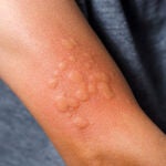 La enfermedad se caracteriza por la aparici&oacute;n de habones con picor e hinchaz&oacute;n