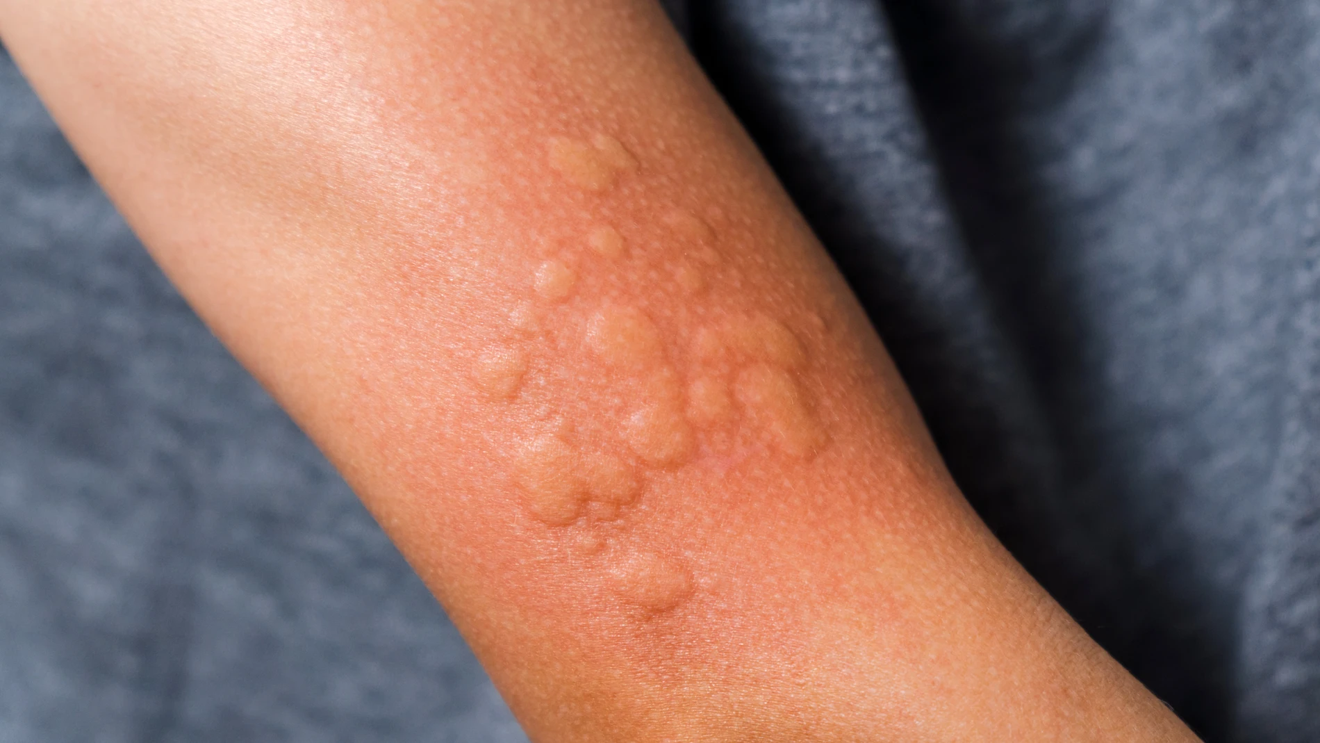 La enfermedad se caracteriza por la aparición de habones con picor e hinchazón