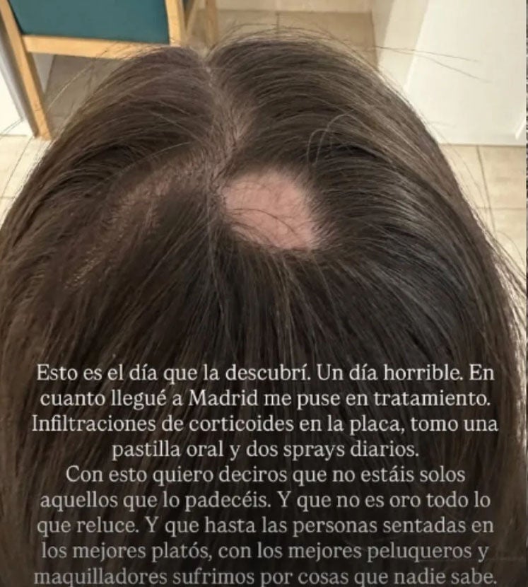 Detalle de la calva de Alexia Rivas por alopecia areata