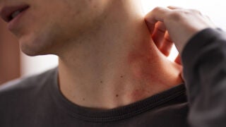 Aumento muy significativo de sarna en j&oacute;venes en Espa&ntilde;a