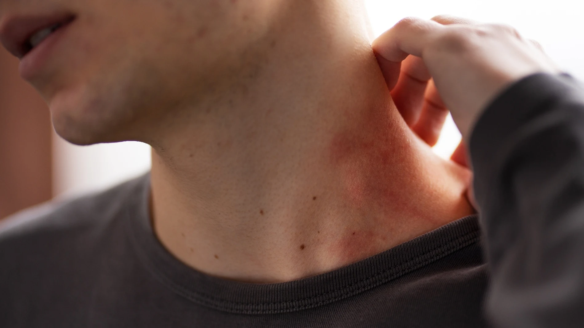 Aumento muy significativo de sarna en jóvenes en España