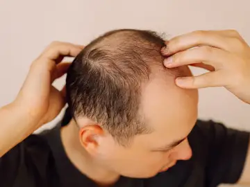 La calvicie tiene solución: Elaboran un fármaco basado en un remedio casero chino que regenera el pelo La calvicie tiene solución: Elaboran un fármaco basado en un remedio casero chino que regenera el pelo