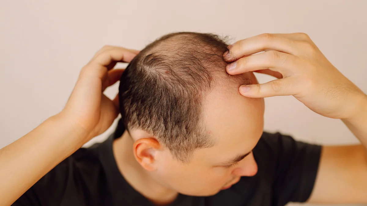 La calvicie tiene solución: Elaboran un fármaco basado en un remedio casero chino que regenera el pelo