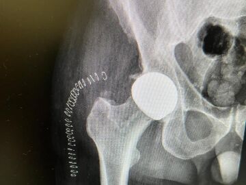Radiograf&iacute;a de una de las pr&oacute;tesis en las que se aprecia la cabeza cer&aacute;mica